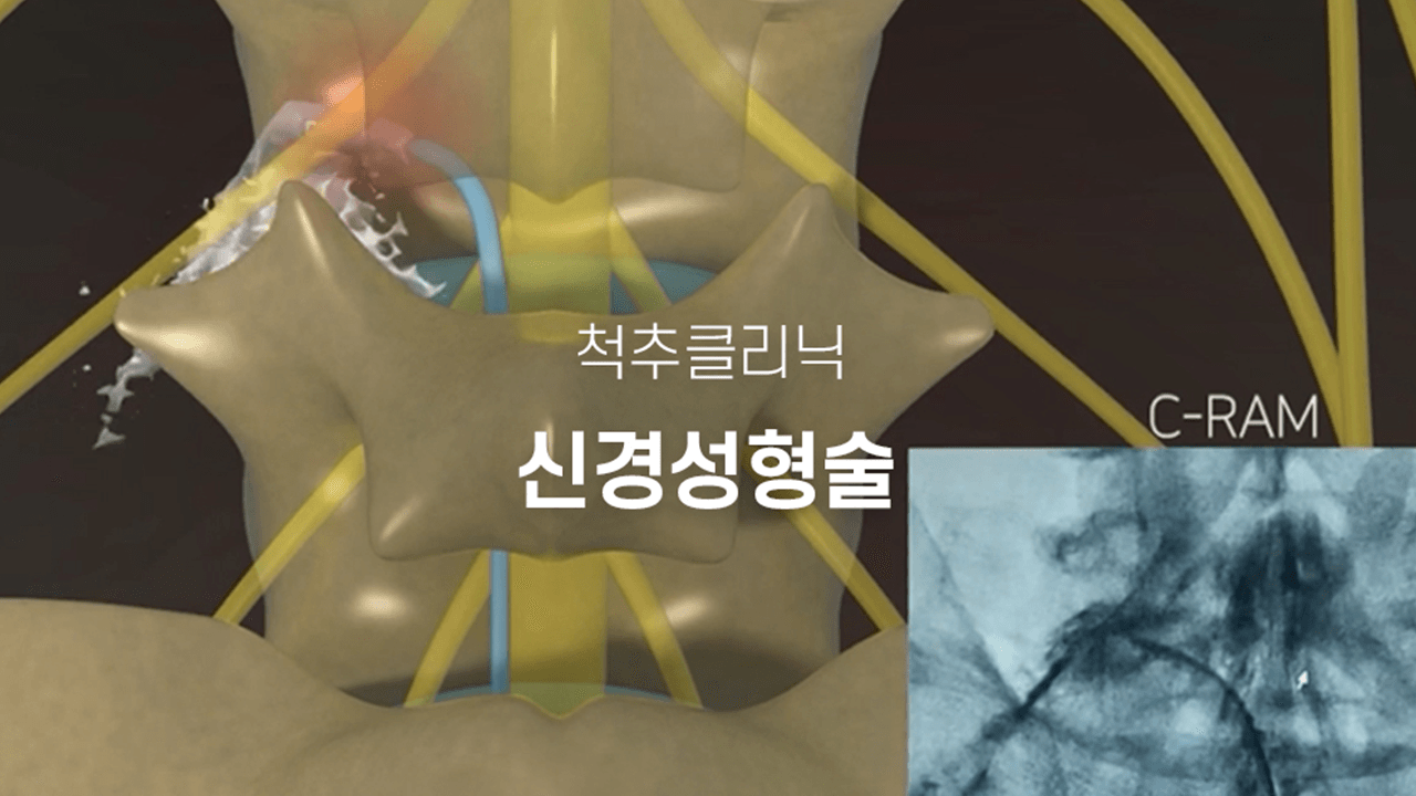 신경성형술