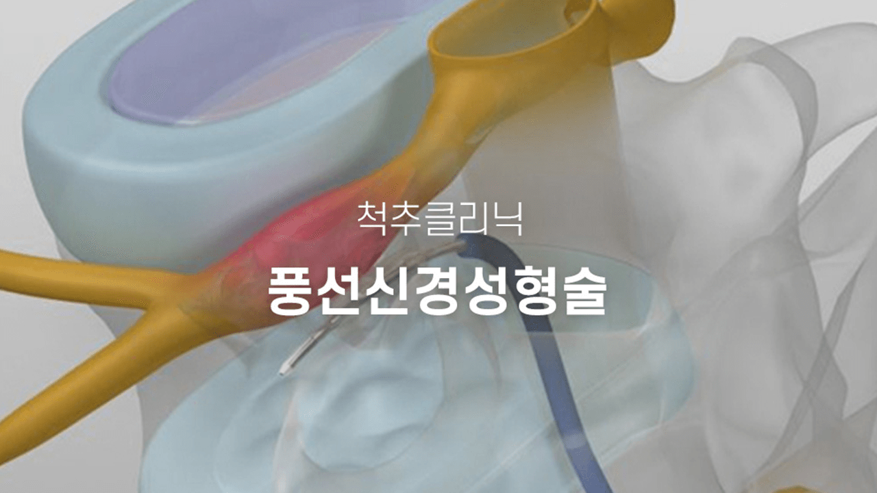 풍선신경성형술