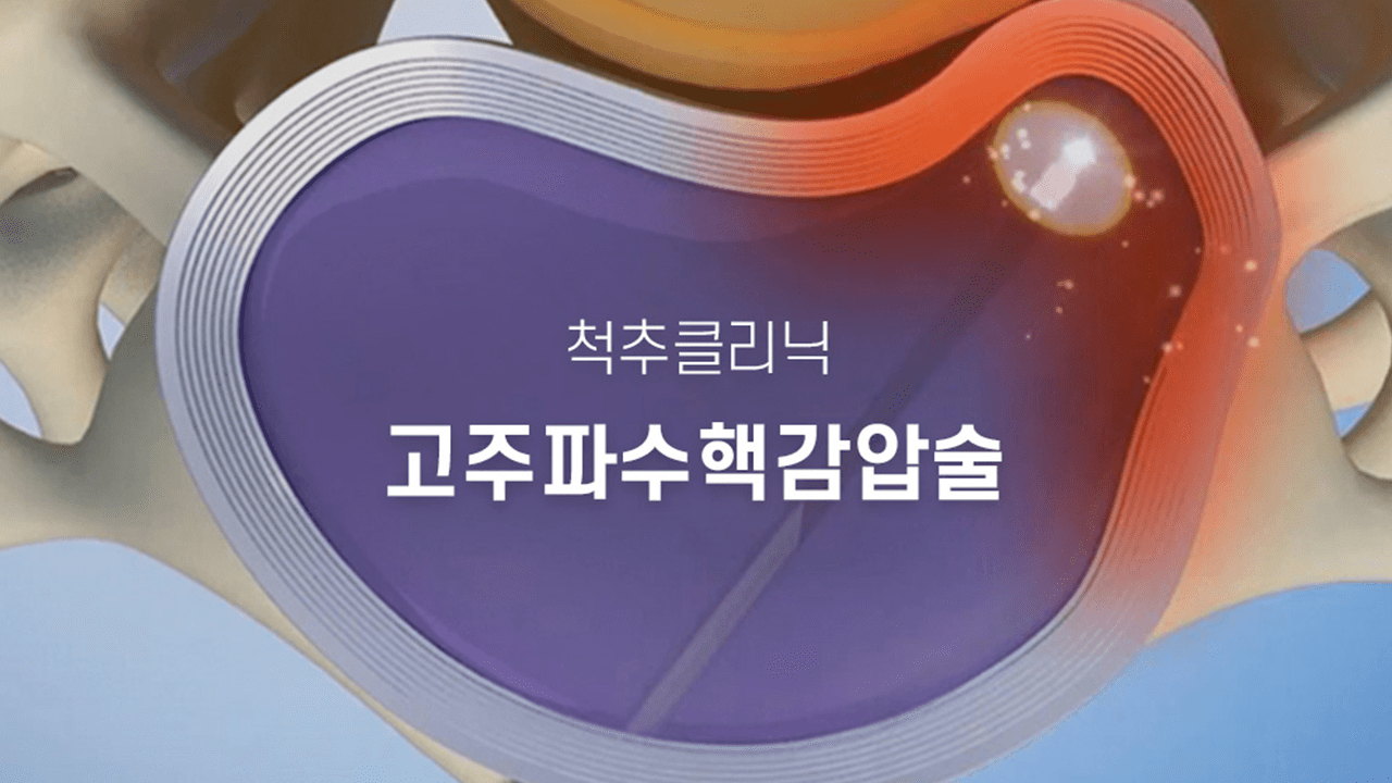 고주파수핵감압술